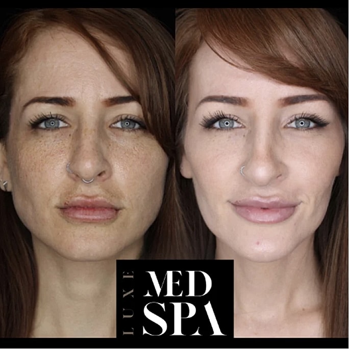 Before and after skin treatment comparison.
